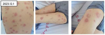 Case report: A case of effective treatment of primary myelofibrosis with nodular panniculitis using ruxolitinib combined with corticosteroids